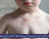 خسرا (چکن پاکس) کی علامات کو کم کرنے کے طریقے؟ کونسی غذا اہم ہے؟